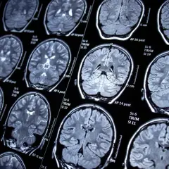 Psychiczne objawy padaczki: Rozpoznaj i odzyskaj równowagę