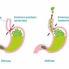 Schemat żołądka pokazuje, jak niedomknięty zwieracz przełyku powoduje cofanie się treści żołądkowej, dając uczucie że coś stoi w przełyku.
