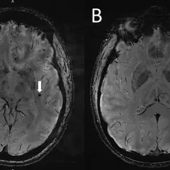 Rezonans głowy a choroby psychiczne: Co naprawdę wykryje MRI?