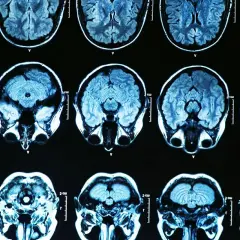 Parkinson: Psychiczne aspekty zrozum, lecz, żyj lepiej