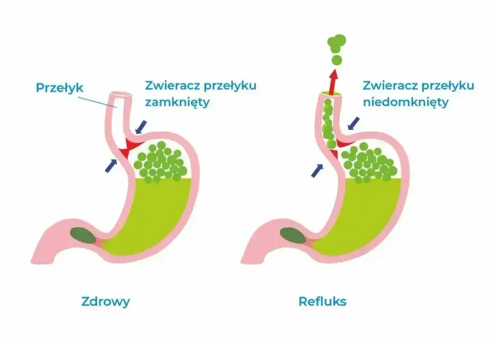 Schemat żołądka pokazuje, jak niedomknięty zwieracz przełyku powoduje cofanie się treści żołądkowej, dając uczucie że coś stoi w przełyku.