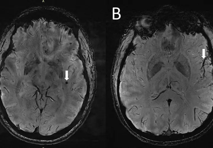 Rezonans głowy a choroby psychiczne: Co naprawdę wykryje MRI?