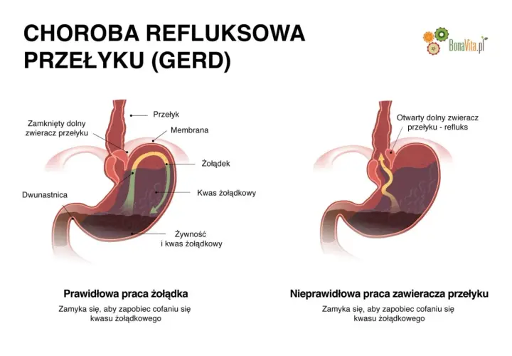 Ilustracja porównująca prawidłową i nieprawidłową pracę zwieracza przełyku, pokazująca refluks żołądkowy.