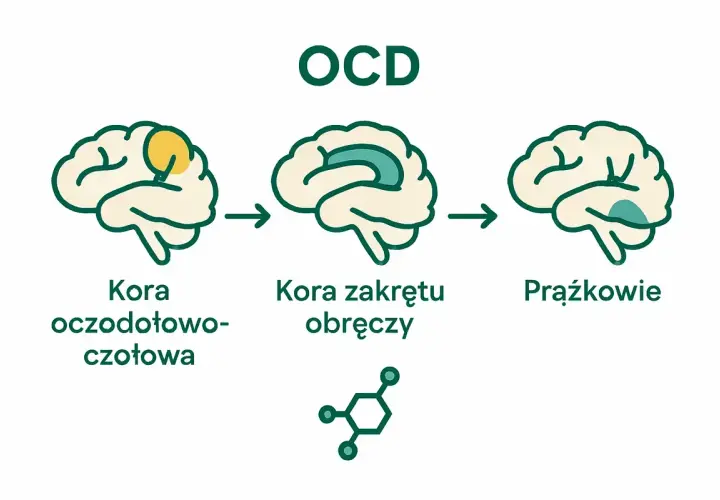 Ilustracja przedstawia mózg z zaznaczonymi obszarami, sugerującymi zmiany związane z OCD chorobą.