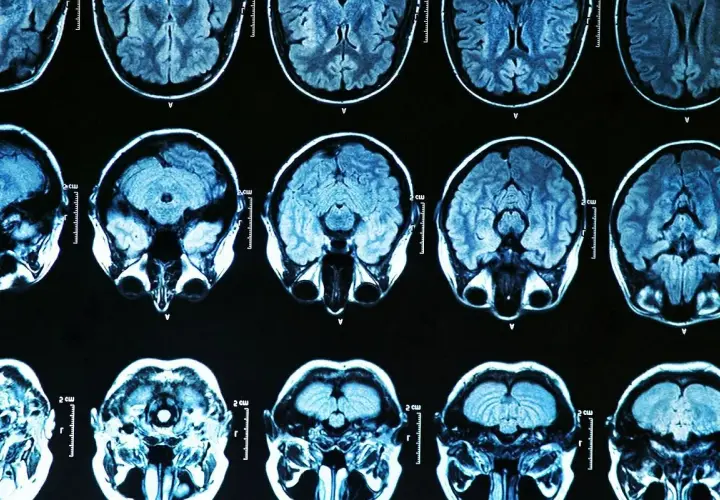 Parkinson: Psychiczne aspekty zrozum, lecz, żyj lepiej