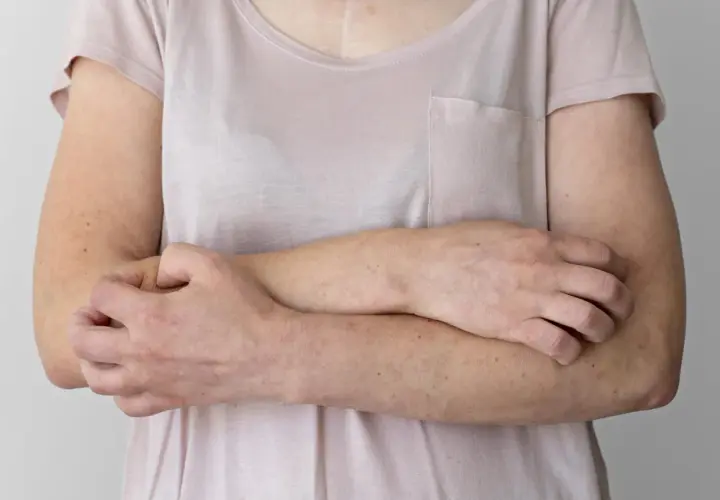 Objawy skórne nerwicy: Czy Twój lęk widać na skórze? Leczenie