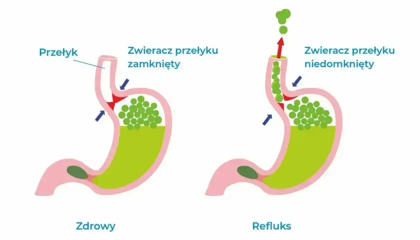 Schemat żołądka pokazuje, jak niedomknięty zwieracz przełyku powoduje cofanie się treści żołądkowej, dając uczucie że coś stoi w przełyku.