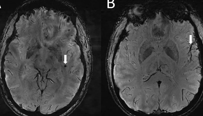 Rezonans głowy a choroby psychiczne: Co naprawdę wykryje MRI?