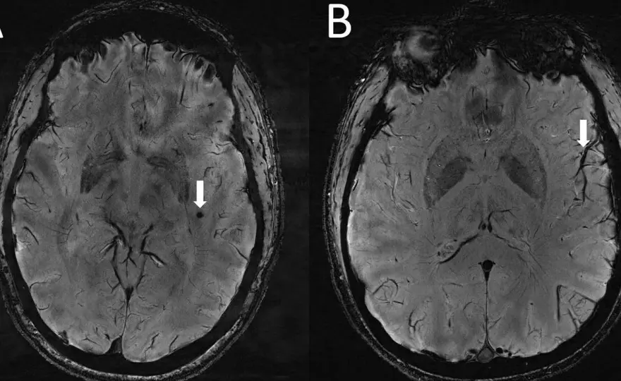 Rezonans głowy a choroby psychiczne: Co naprawdę wykryje MRI?