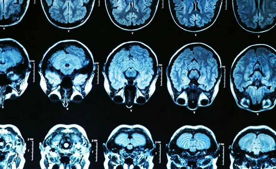 Parkinson: Psychiczne aspekty zrozum, lecz, żyj lepiej