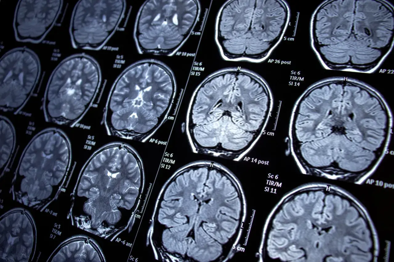 Psychiczne objawy padaczki: Rozpoznaj i odzyskaj równowagę