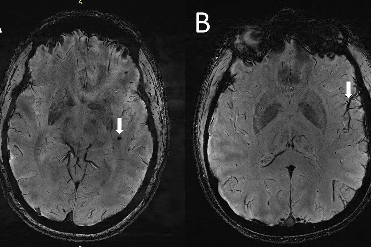 Rezonans głowy a choroby psychiczne: Co naprawdę wykryje MRI?