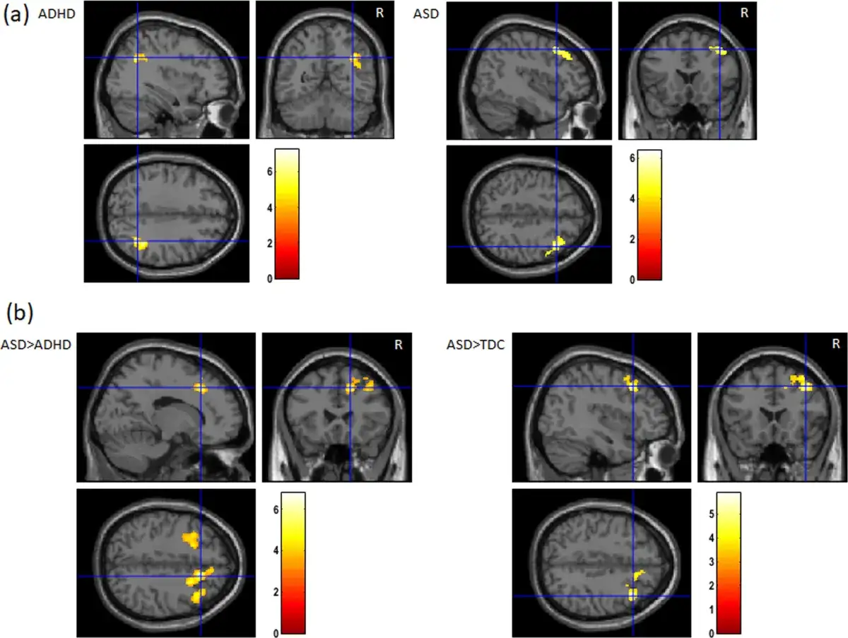 Aktywacja mózgu w ADHD i ASD. Różnice w spektrum co to, pokazane na obrazach fMRI.